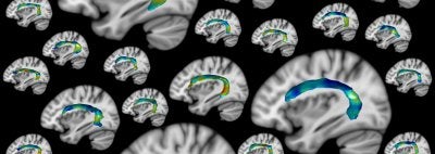 Brain images with white matter tracts emphasized